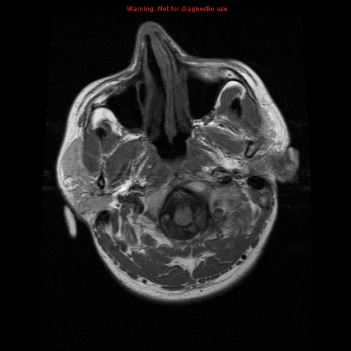 File:Atypical meningioma - grade II (Radiopaedia 13303-13305 Axial T1 2).jpg