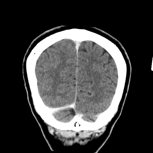 Atypical meningioma with skull invasion (Radiopaedia 34357-35649 Coronal C+ delayed 51).png