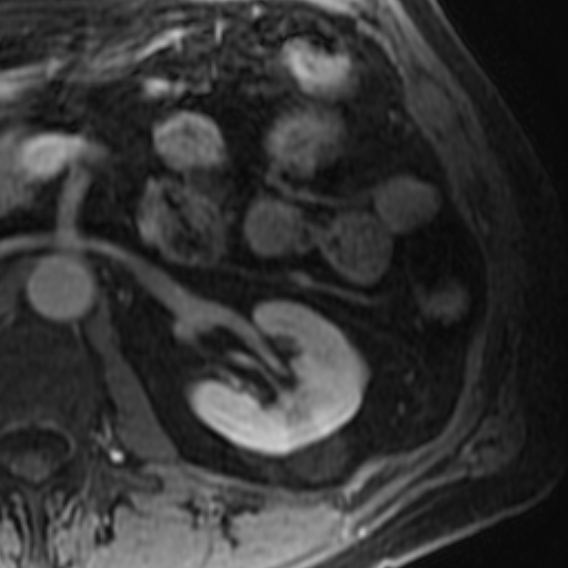 File:Atypical renal cyst on MRI (Radiopaedia 17349-17046 D 15).jpg