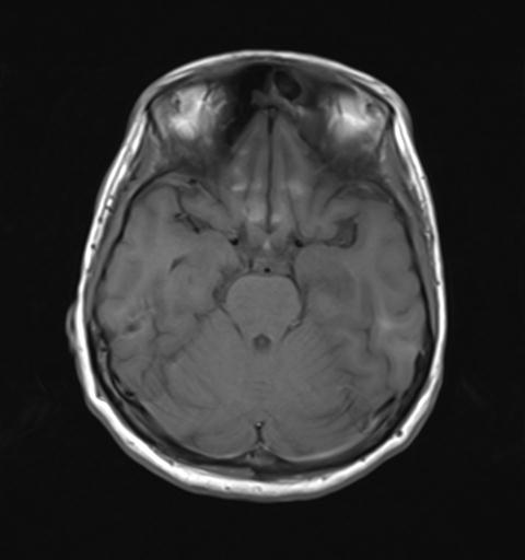 File:Autoimmune limbic encephalitis (Radiopaedia 30363-31005 Axial T1 12).jpg