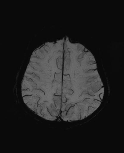 Autoimmune limbic encephalitis (Radiopaedia 30363-31005 SWI - mIP 53).jpg