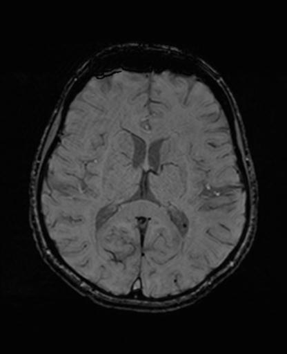 Autoimmune limbic encephalitis (Radiopaedia 30363-31005 SWI 44).jpg