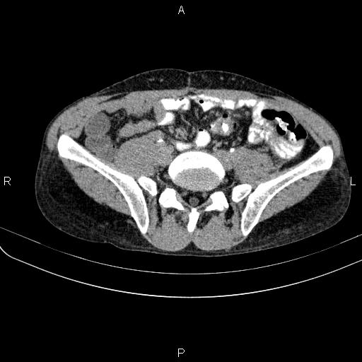 Autoimmune pancreatitis (Radiopaedia 84925-100431 Axial C+ delayed 62).jpg