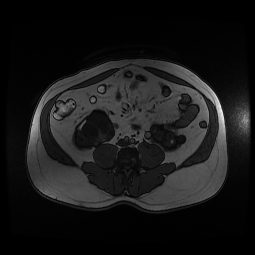 Autosomal dominant polycystic kidney disease (Radiopaedia 50259-55611 Axial 2D Dual Echo 65).jpg