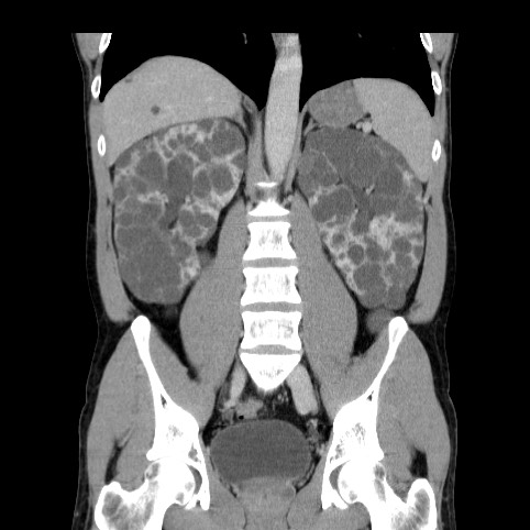 Autosomal dominant polycystic kidney disease (Radiopaedia 66349-75582 A 53).jpg