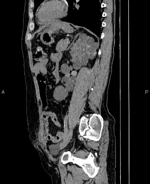 Autosomal dominant polycystic kidney disease (Radiopaedia 87830-104287 C 61).jpg