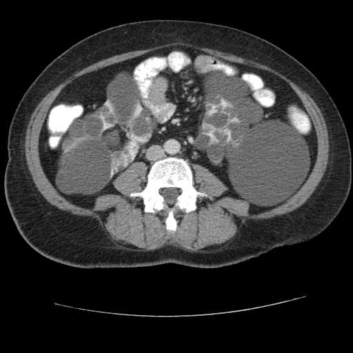 Autosomal dominant polycystic kidney disease with hepatic involvement (Radiopaedia 32693-33662 B 47).jpg