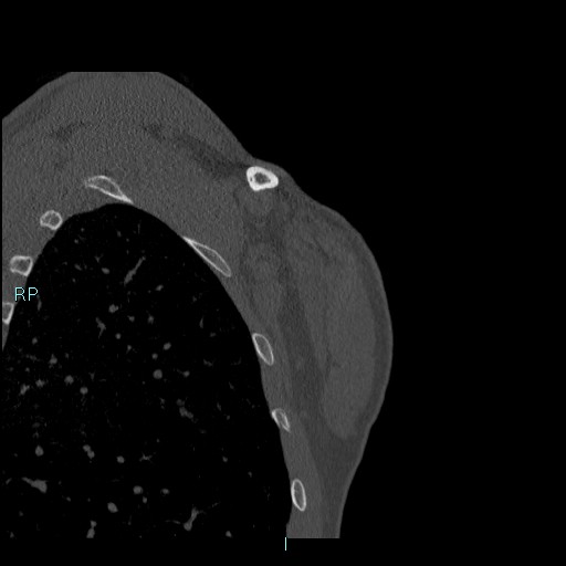 Avascular necrosis after fracture dislocations of the proximal humerus (Radiopaedia 88078-104655 Coronal bone window 125).jpg