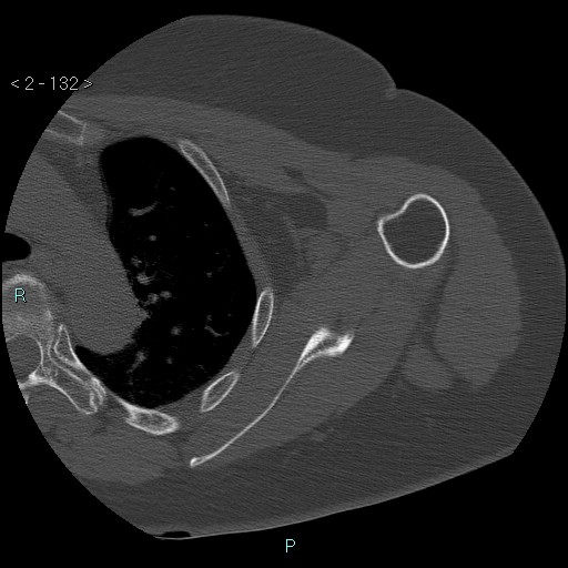 Avascular necrosis of the shoulder - Cruess stage I (Radiopaedia 77674-89887 Axial bone window 33).jpg