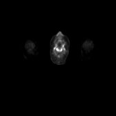 B-cell lymphoma of the mesentery (Radiopaedia 65743-74868 18F-FDG PET-CT 260).jpg