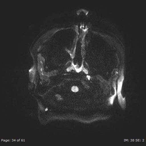 Balo concentric sclerosis (Radiopaedia 61637-69636 Axial DWI 34).jpg