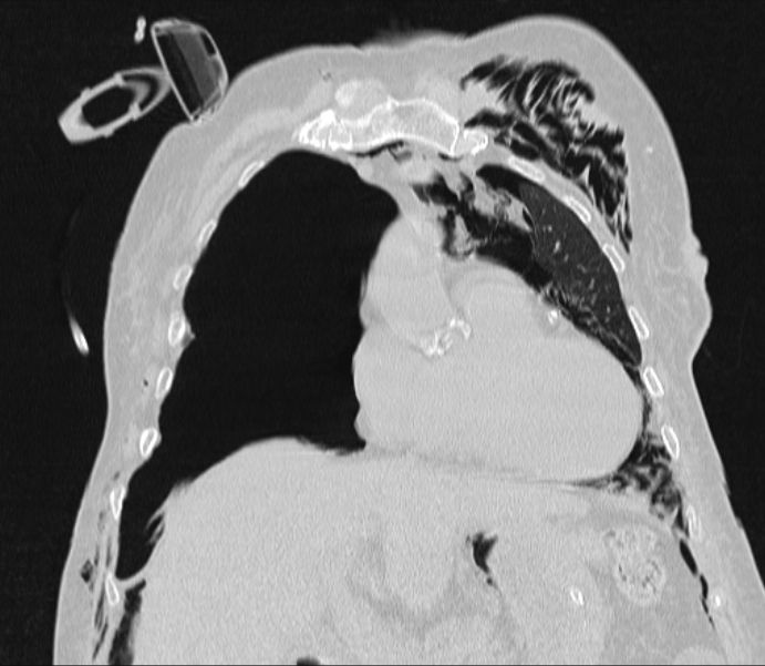 Barotrauma due to mechanical ventilation (Radiopaedia 28079-28336 Coronal lung window 35).jpg