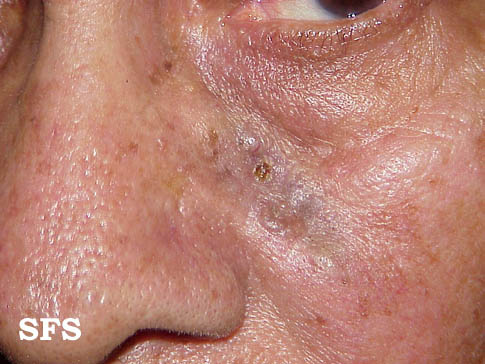 Basal Cell Carcinoma (Dermatology Atlas 10).jpg