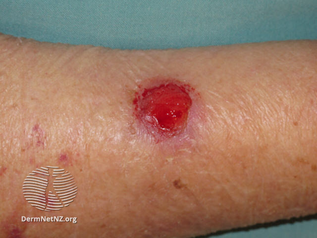 File:Basal cell carcinoma, arm (DermNet NZ bcc-arm-13-dn).jpg