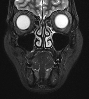 File:Basal cell carcinoma - nasal region (Radiopaedia 70292-80365 Coronal STIR 12).jpg