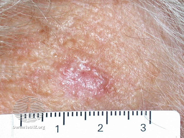 File:Basal cell carcinoma affecting the trunk (DermNet NZ lesions-bcc-trunk-1147).jpg