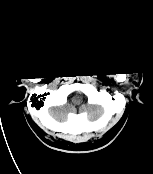 File:Basal ganglia hemorrhage - hypertensive (Radiopaedia 42227-45304 Axial non-contrast 3).png