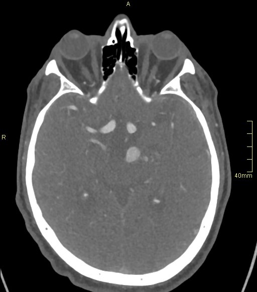 Basilar artery aneurysm (Radiopaedia 56261-62932 A 75).jpg