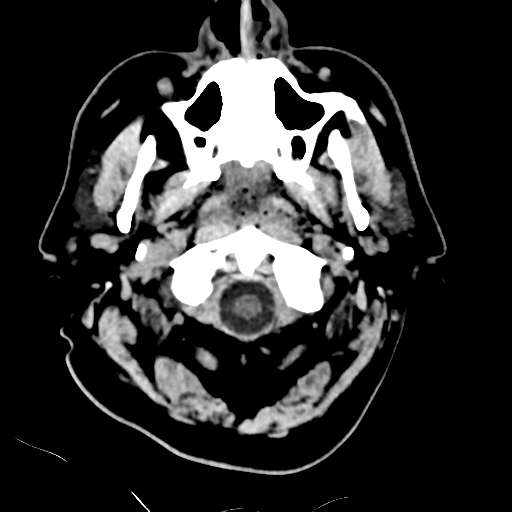 File:Basilar artery occlusion (Radiopaedia 33570-34659 Axial non-contrast 4).png