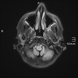 File:Basilar artery perforator aneurysm (Radiopaedia 82455-99523 Axial FLAIR 3).jpg