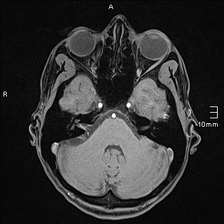 Basilar artery perforator aneurysm (Radiopaedia 82455-99523 F 31).jpg