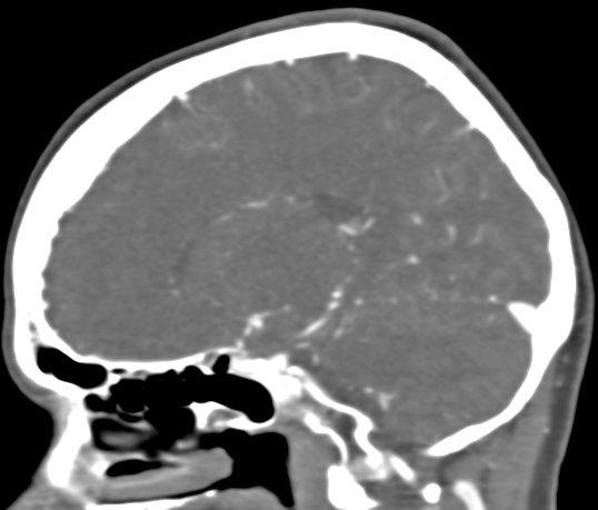 Basilar tip aneurysm with coiling (Radiopaedia 53912-60086 C 51).jpg