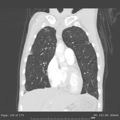 Behçet disease (Radiopaedia 44247-47889 Coronal lung window 46).jpg