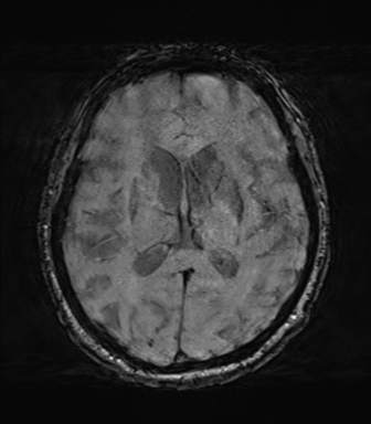 Behavioral variant frontotemporal dementia and late onset schizophrenia (Radiopaedia 52197-58083 Axial SWI 41).png