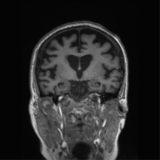 Behavioral variant frontotemporal dementia and late onset schizophrenia (Radiopaedia 52197-58083 Coronal T1 52).png