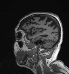 Behavioral variant frontotemporal dementia and late onset schizophrenia (Radiopaedia 52197-58083 Sagittal T1 14).png