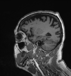 Behavioral variant frontotemporal dementia and late onset schizophrenia (Radiopaedia 52197-58083 Sagittal T1 77).png