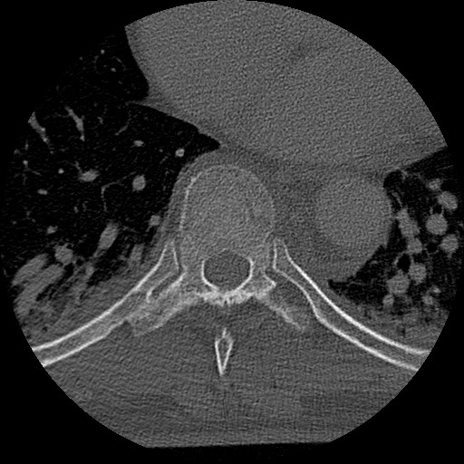 Benign post-traumatic pseudopneumoperitoneum (Radiopaedia 71199-81495 Axial bone window 117).jpg