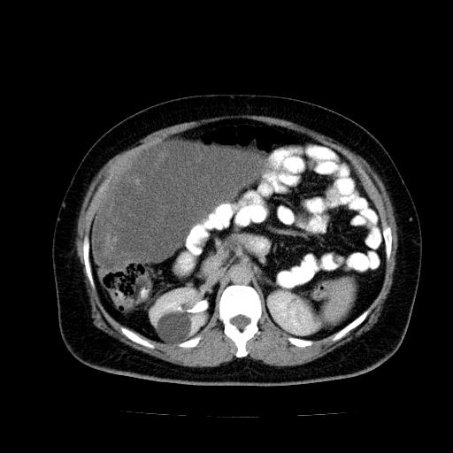 Benign spindle cell tumor - abdominopelvic (Radiopaedia 61300-69212 Axial C+ delayed 23).jpg