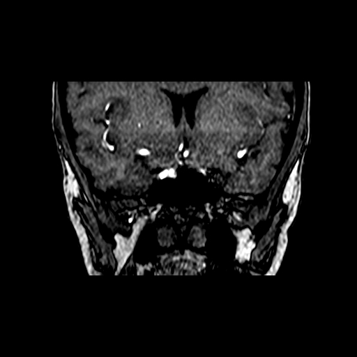 Berry aneurysm of the terminal internal carotid artery (Radiopaedia 88286-104918 Coronal TOF 29).jpg