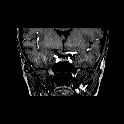 File:Berry aneurysm of the terminal internal carotid artery (Radiopaedia 88286-104918 Coronal TOF 37).jpg