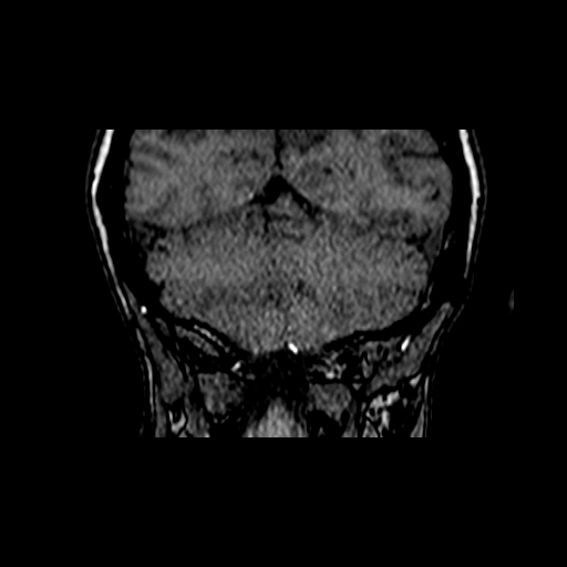 File:Berry aneurysm of the terminal internal carotid artery (Radiopaedia 88286-104918 Coronal TOF 95).jpg