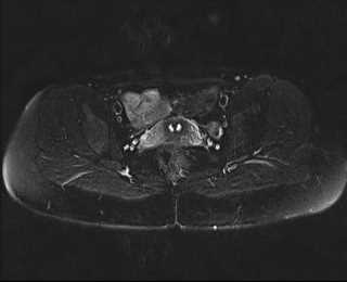 File:Bicornuate bicollis uterus (Radiopaedia 61626-69616 Axial PD fat sat 22).jpg