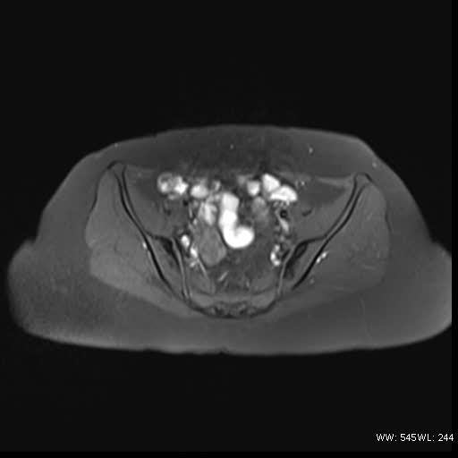File:Bicornuate uterus- on MRI (Radiopaedia 49206-54297 Axial T1 fat sat 7).jpg