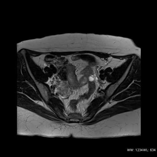 File:Bicornuate uterus- on MRI (Radiopaedia 49206-54297 Axial T2 5).jpg