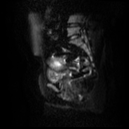 File:Bicornuate uterus (Radiopaedia 51676-57472 Sagittal DWI 15).jpg