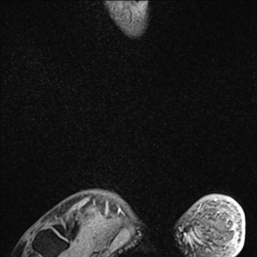 Bilateral Achilles tendon complete tear (Radiopaedia 81344-95051 Sagittal WE - Right 102).jpg