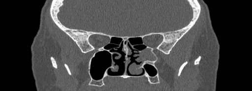 Bilateral Ectopic Infraorbital Nerves (Radiopaedia 49006-54084 Coronal bone window 53).jpg