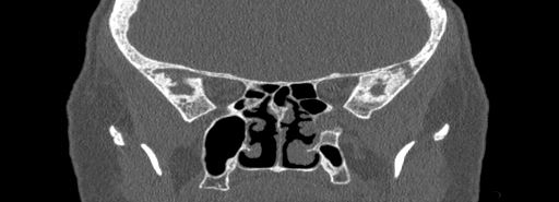 File:Bilateral Ectopic Infraorbital Nerves (Radiopaedia 49006-54084 Coronal bone window 56).jpg