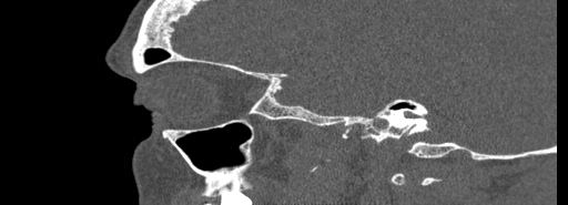 Bilateral Ectopic Infraorbital Nerves (Radiopaedia 49006-54084 Sagittal bone window 10).jpg