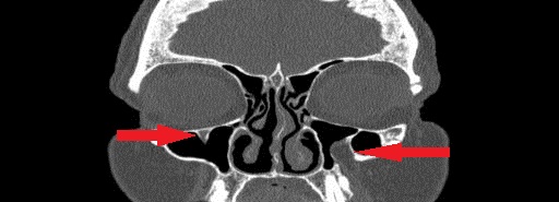File:Bilateral Ectopic Infraorbital Nerves (Radiopaedia 49006-58325 Coronal 5).jpg