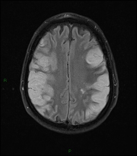 File:Bilateral acute middle cerebral artery territory infarcts (Radiopaedia 77319-89402 Axial FLAIR 17).jpg
