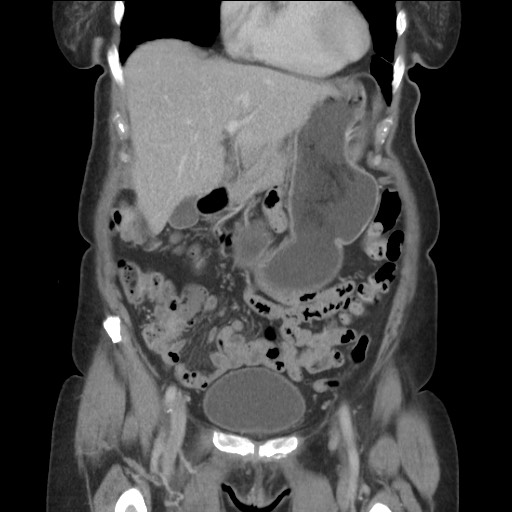 Bilateral adrenal granulocytic sarcomas (chloromas) (Radiopaedia 78375-91007 B 32).jpg