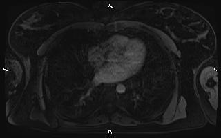 Bilateral adrenal myelolipoma (Radiopaedia 63058-71537 Axial T1 C+ fat sat 2).jpg