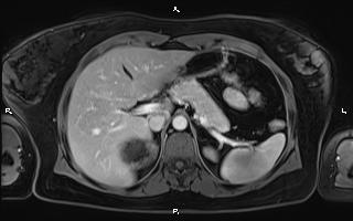 Bilateral adrenal myelolipoma (Radiopaedia 63058-71537 G 30).jpg