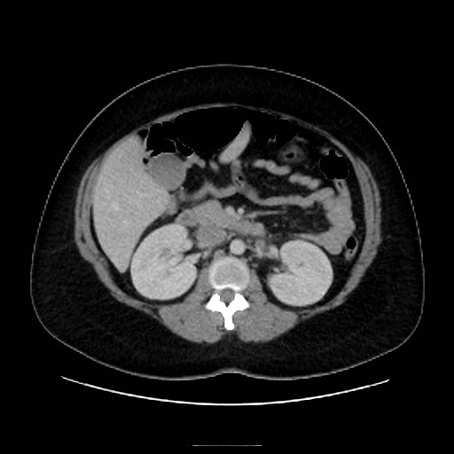 Bilateral adrenal thrombosis (Radiopaedia 58182-65256 A 29).jpg
